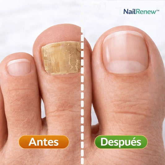 NailRenew™ Elimina el hongo y repara tus uñas